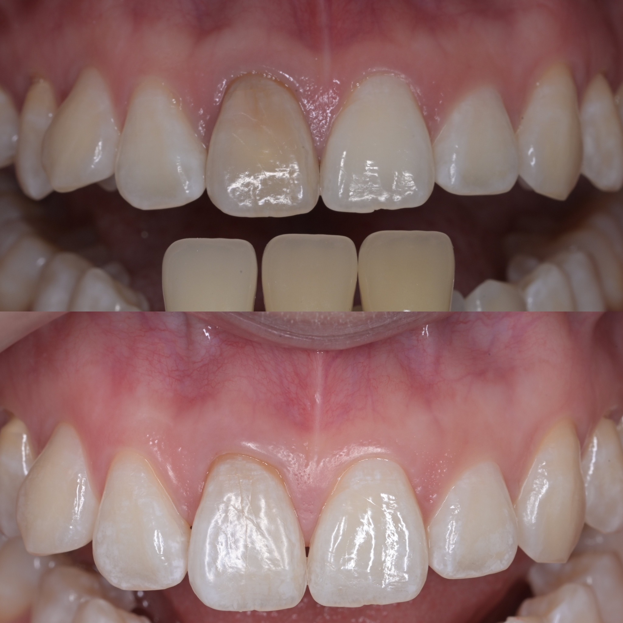 1本だけ変色した前歯をインターナルブリーチで白い歯に！