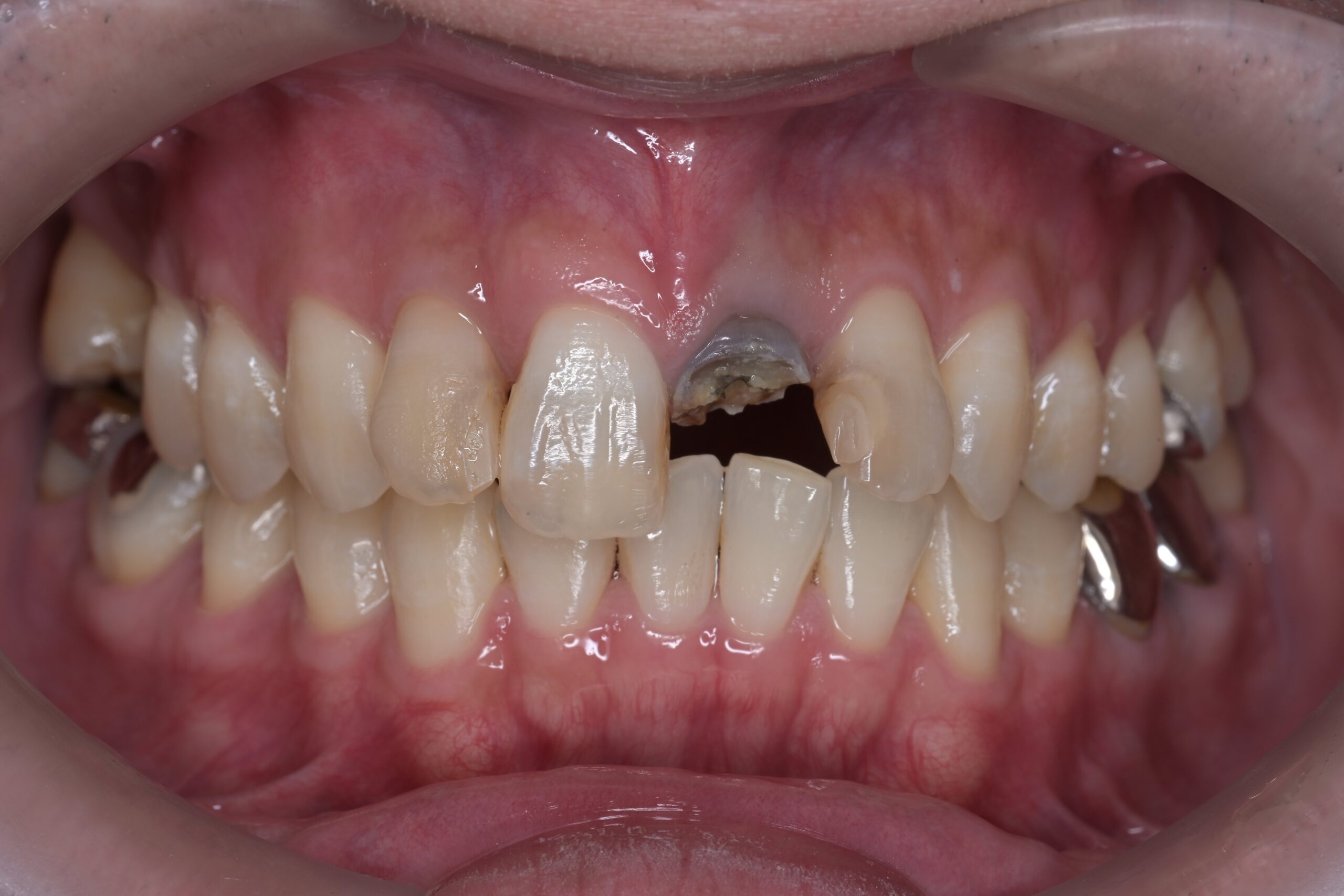 前歯が折れた!!