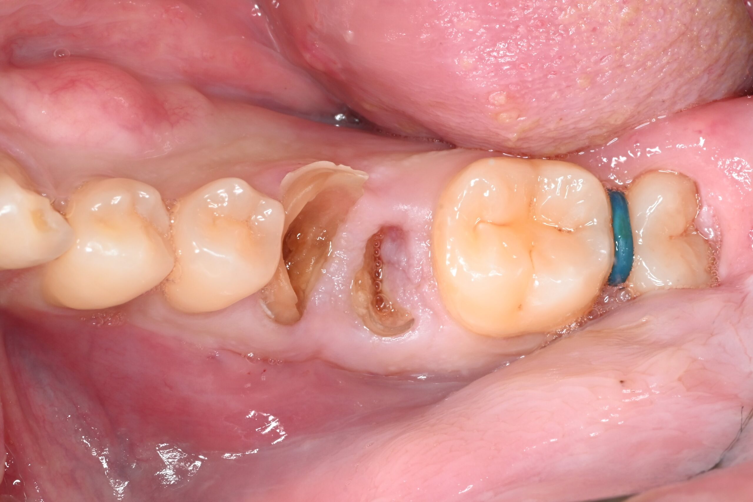 自家歯牙移植によってインプラントを回避